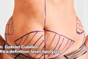 Dr. Gabriel Cubillos: Ultra-definition laser lipolysis in Trinidad and Tobago
